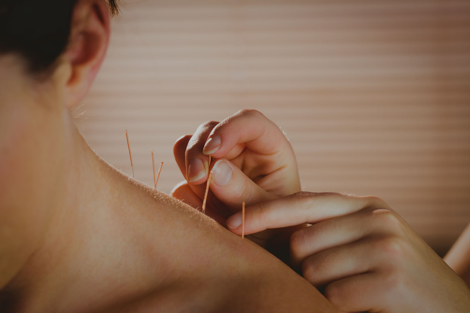 acupuncture-kumeu